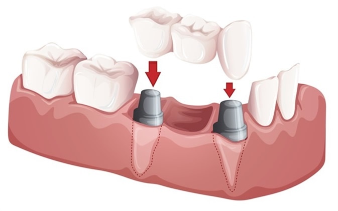 Illustration of a dental bridge. Image Credit: BlueRingMedia / Shutterstock